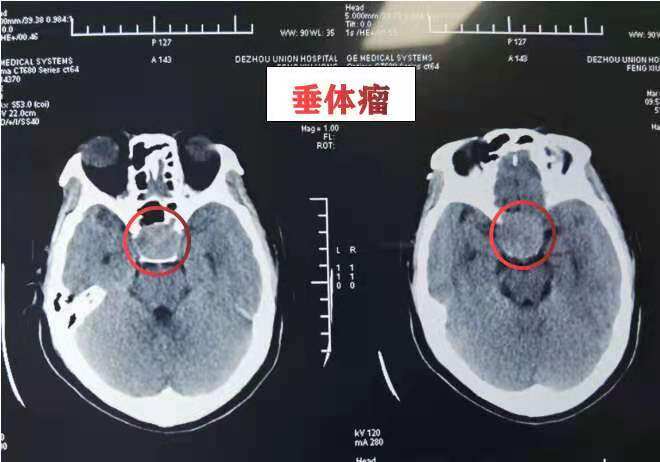 无故头痛眼花,当心垂体瘤!